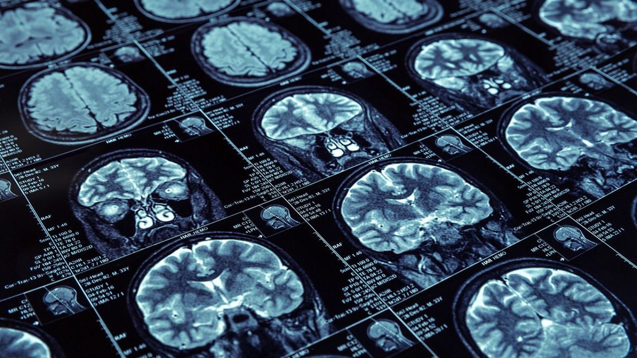 diversas imagens de um cérebro em resultado de exame de ressonância magnética